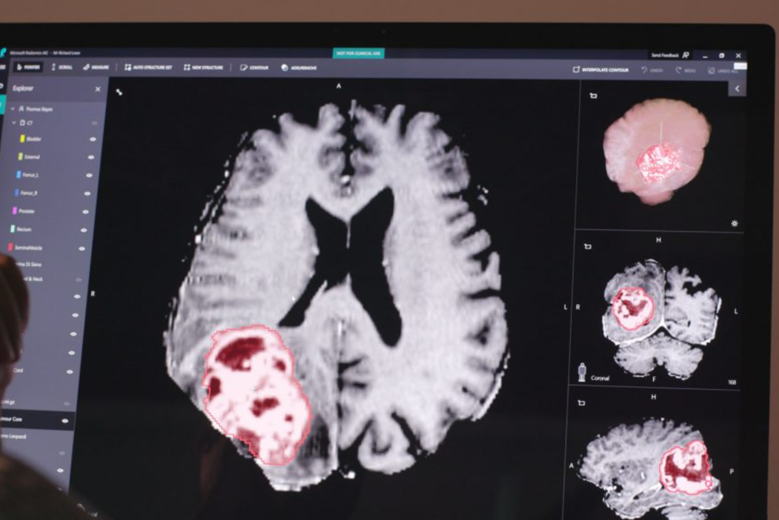 interface logicielle InnerEye montrant l'analyse IA d'imagerie médicale cérébrale en 3D
